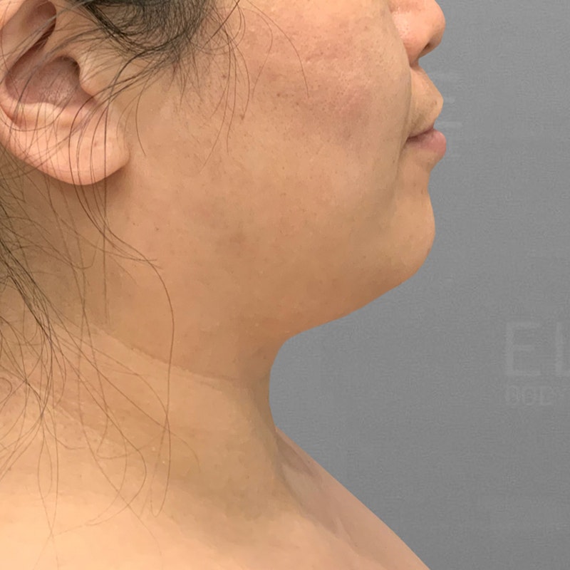 before chin airsculpt