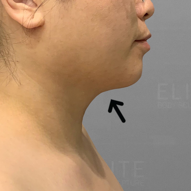 after chin airsculpt