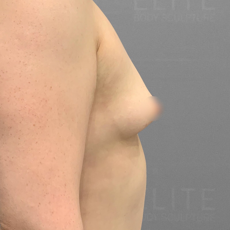 before airsculpt up a cup