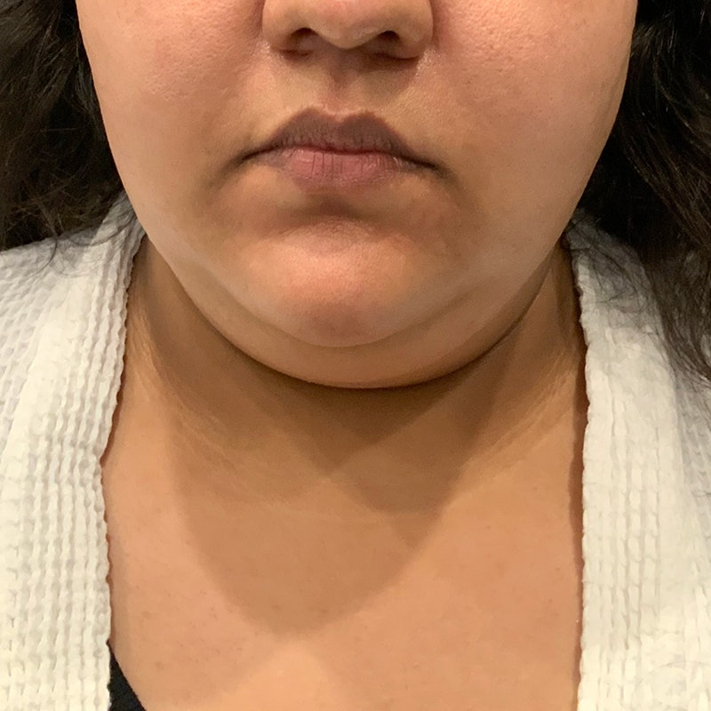 before chin liposuction