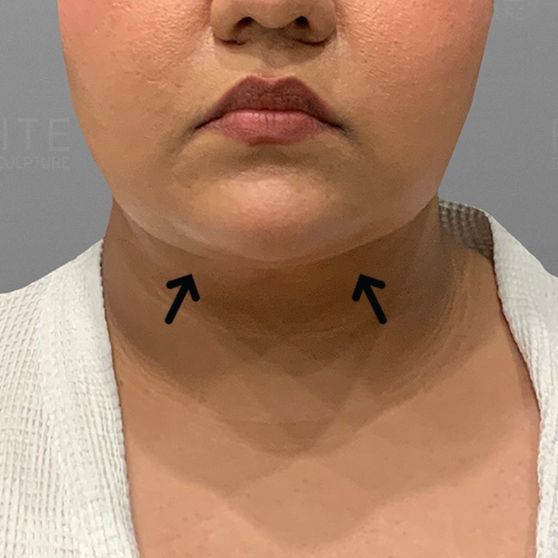 after chin liposuction