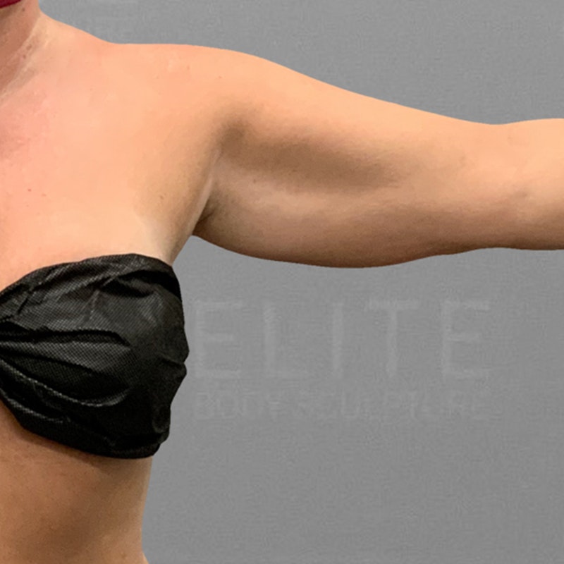 before arm airsculpt
