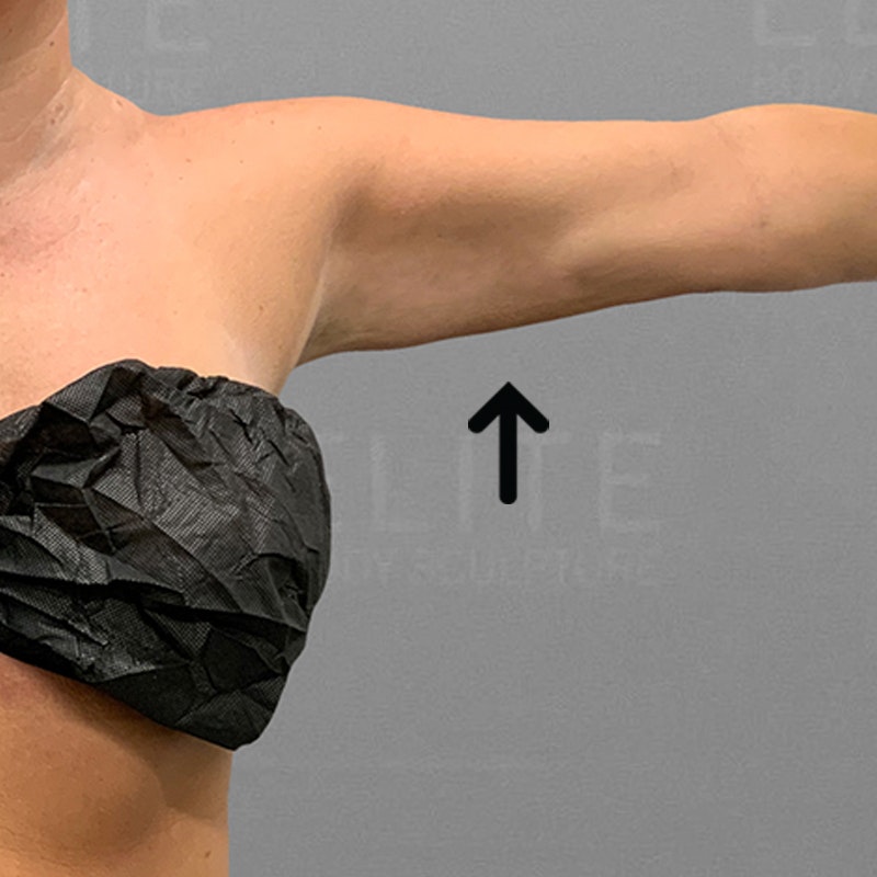 after arm airsculpt