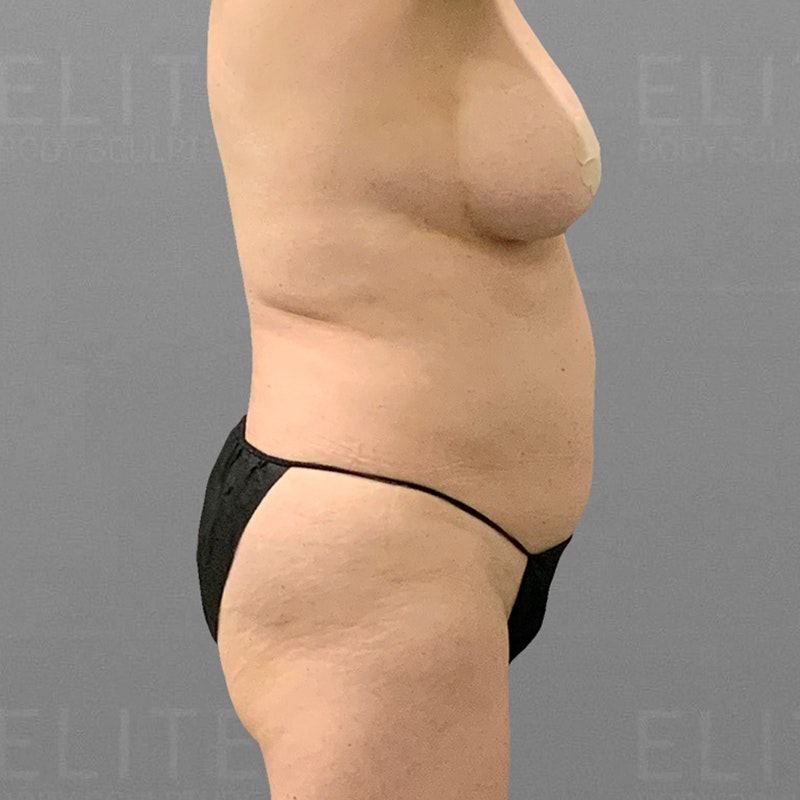 before stomach airsculpt