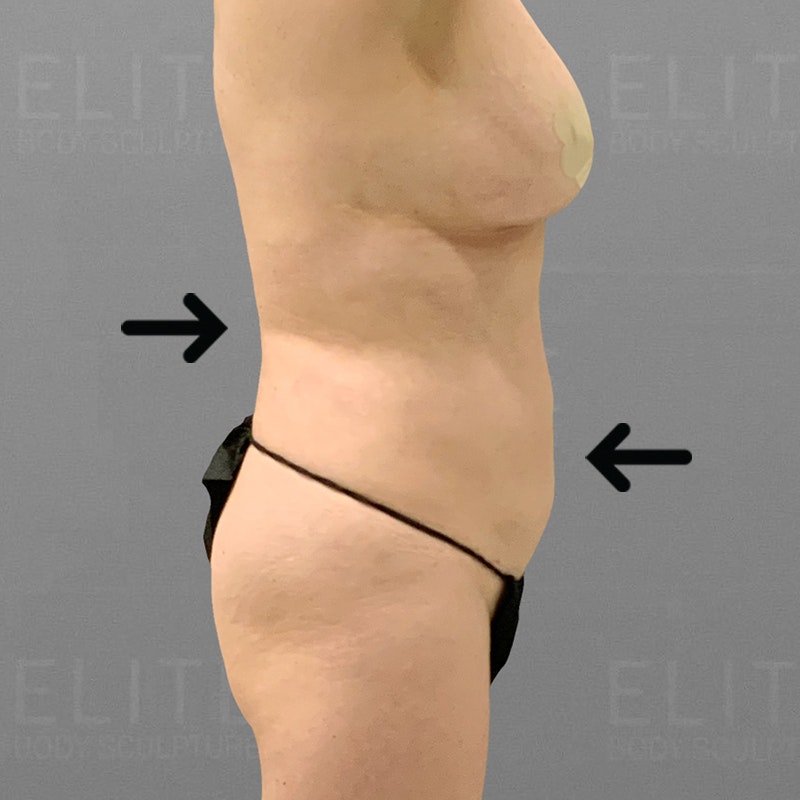 after stomach and upper back airsculpt