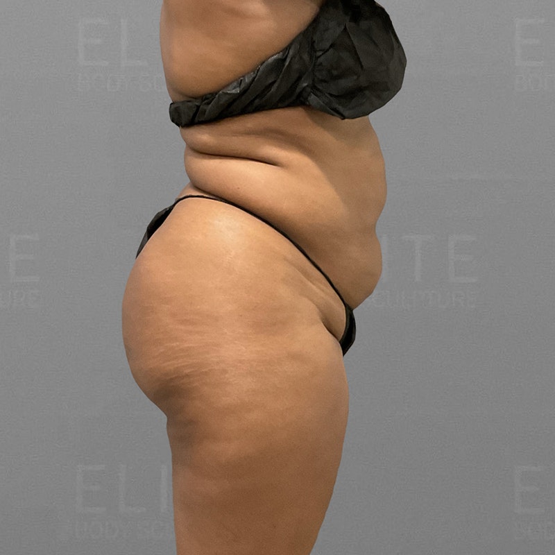 before stomach and back bra roll airsculpt