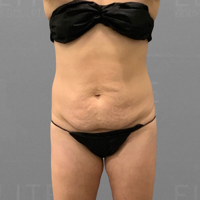 Before AirSculpt Tiny Tuck