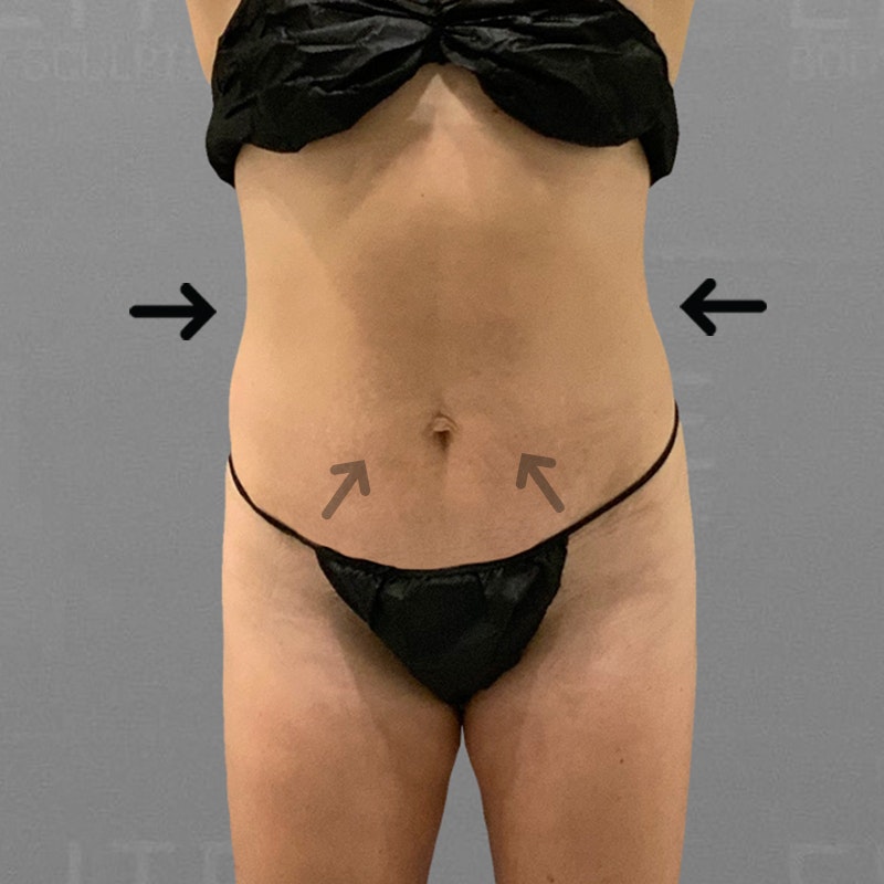 After AirSculpt Tiny Tuck