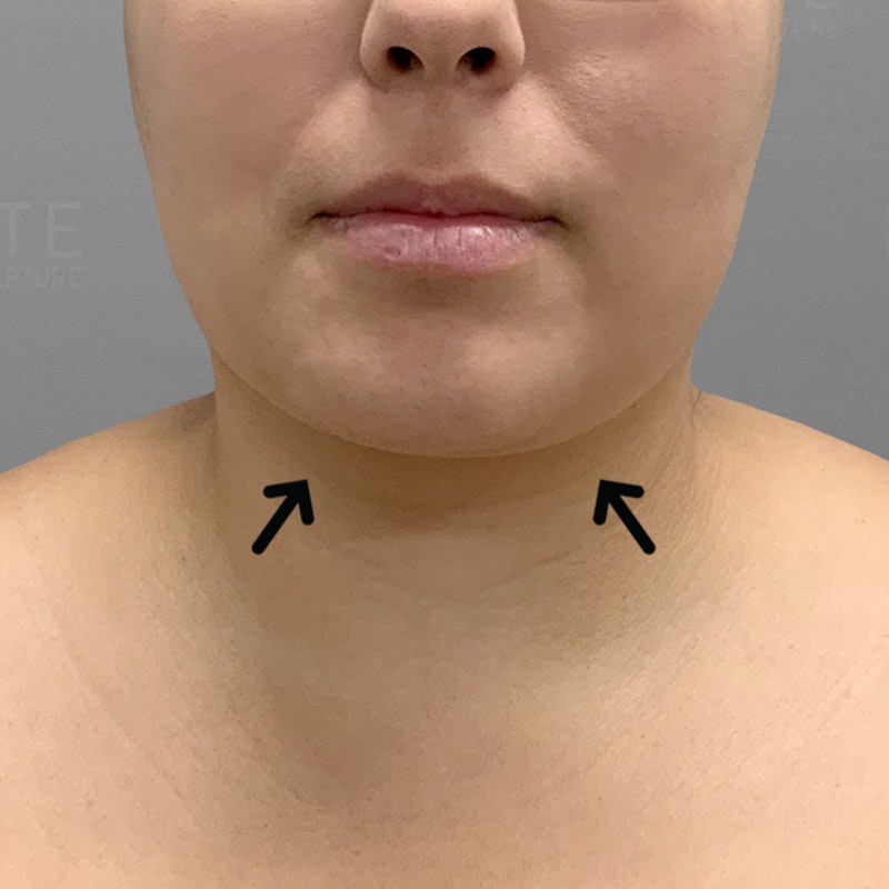 after chin airsculpt