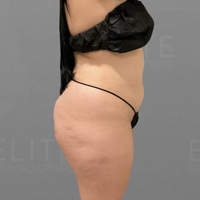 before full abdominal airsculpt