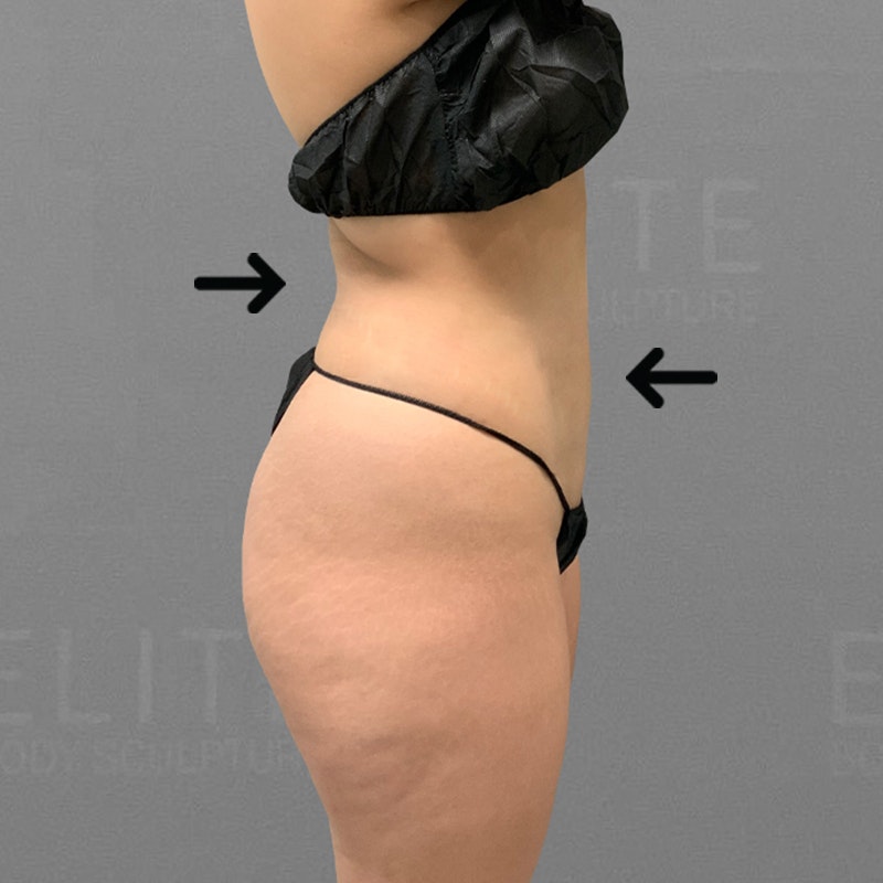 after full abdominal airsculpt