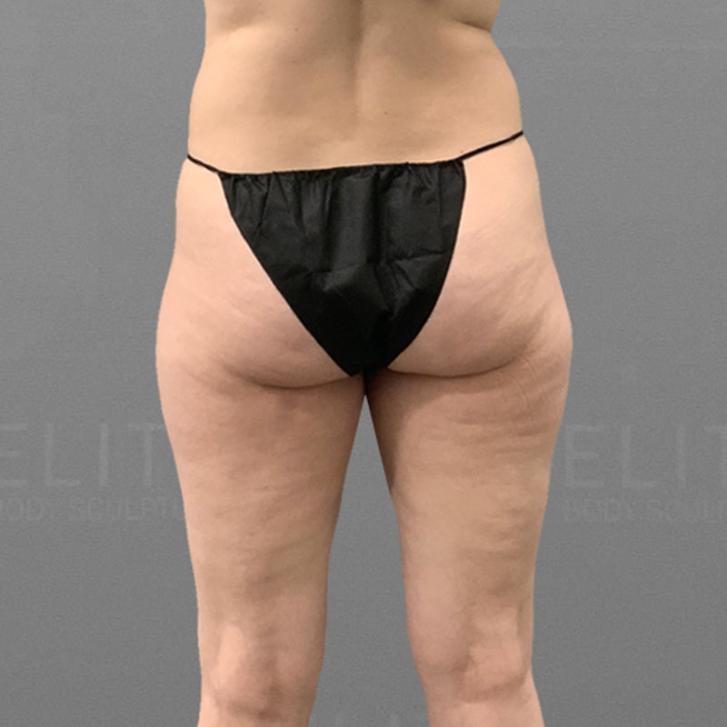 before inner and outer thigh airsculpt