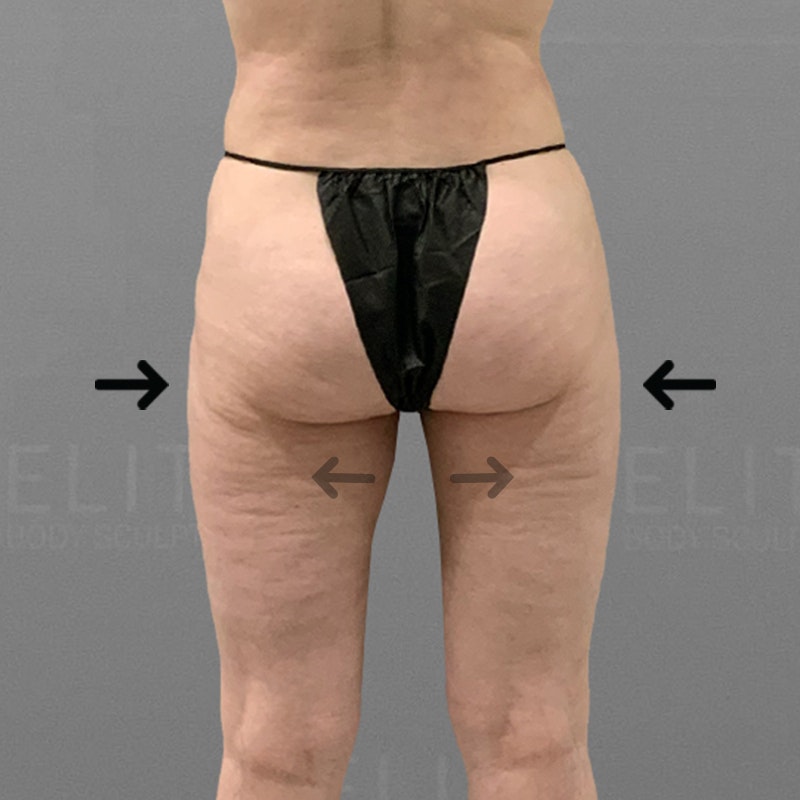 after inner and outer thigh airsculpt