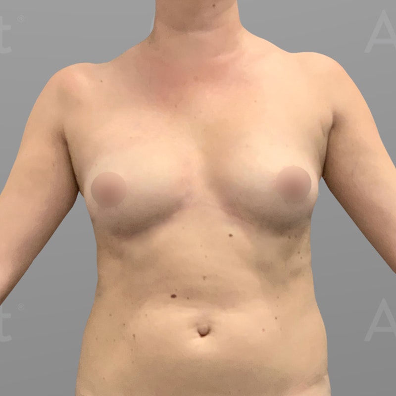 before stomach and up a cup airsculpt