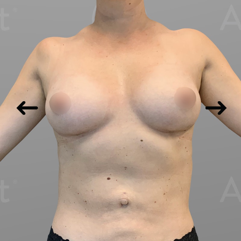 after stomach and up a cup airsculpt