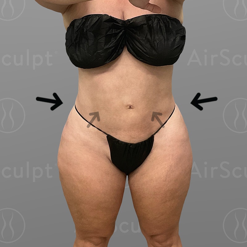 after stomach airsculpt