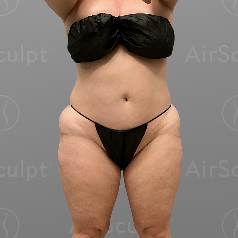 before stomach airsculpt