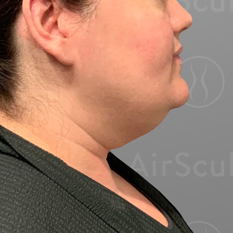 before chin liposuction