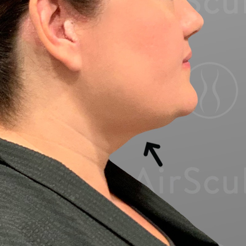 after chin liposuction
