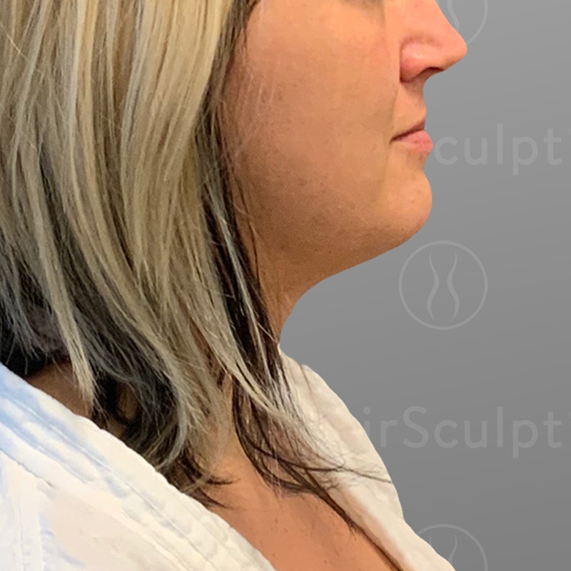 before chin airsculpt