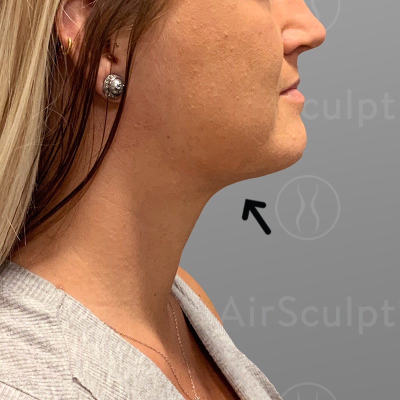 after chin airsculpt