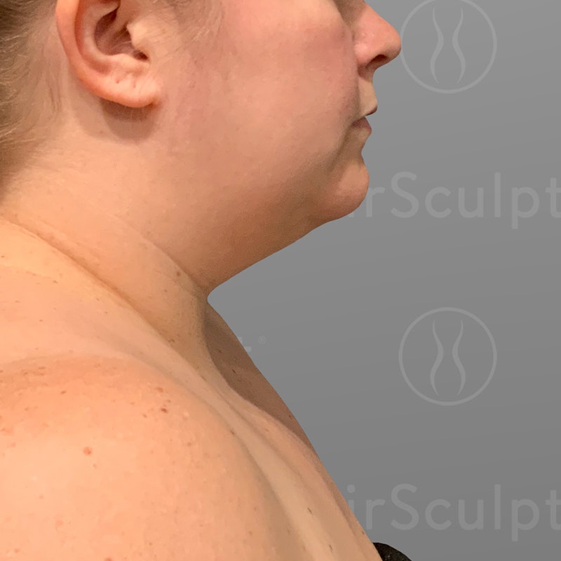 before chin airsculpt