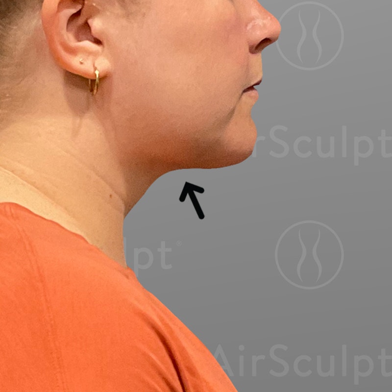 after chin airsculpt