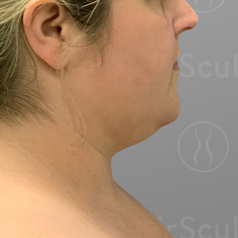 before chin airsculpt