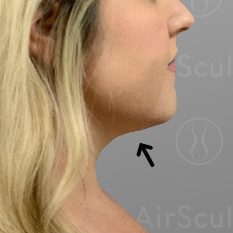 after chin airsculpt