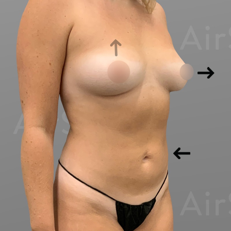 Morgan Bullard's after AirSculpt Up a Cup shot