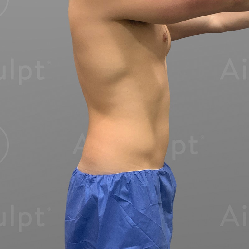 Drew Bullard's before Waist AirSculpt shot
