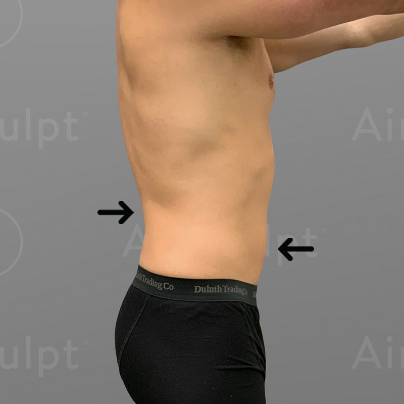 Drew Bullard's after Waist AirSculpt shot