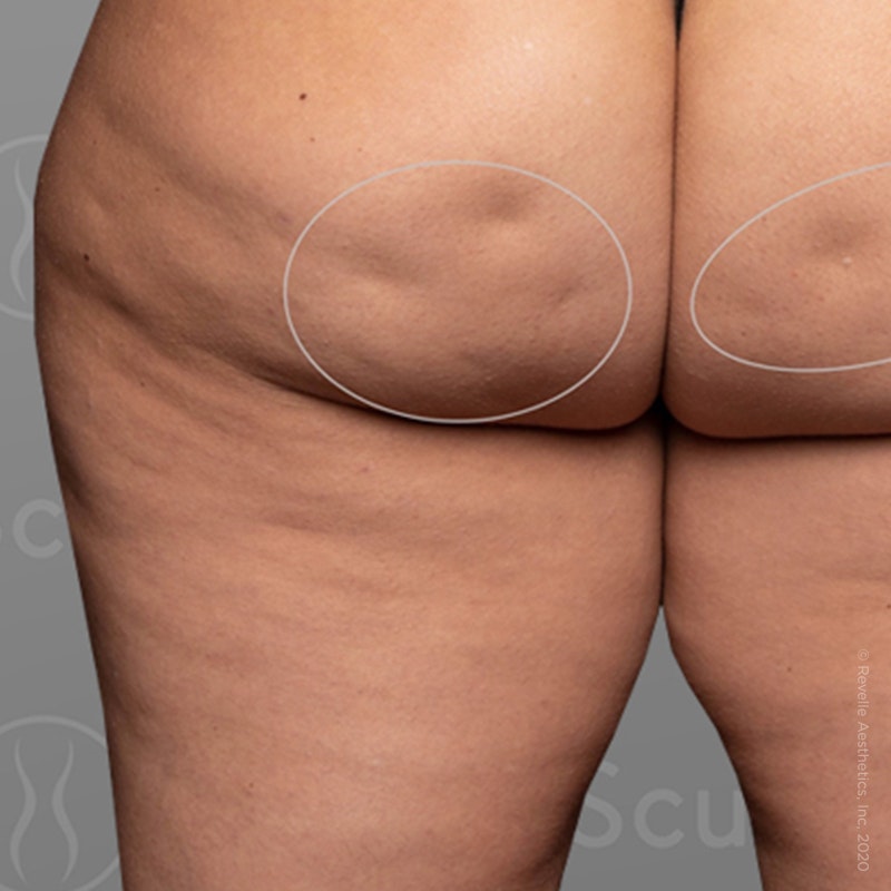 before photo of AirSculpt Smooth cellulite removal