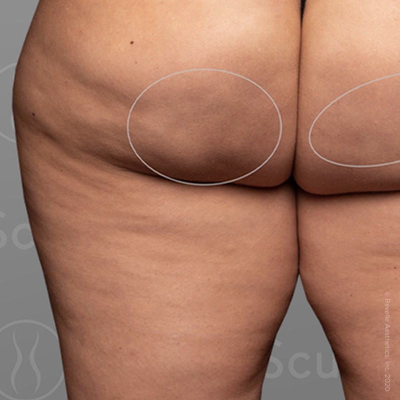 after photo of AirSculpt Smooth cellulite removal