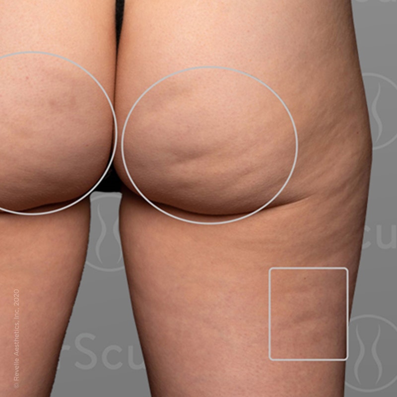 before photo of AirSculpt Smooth cellulite removal