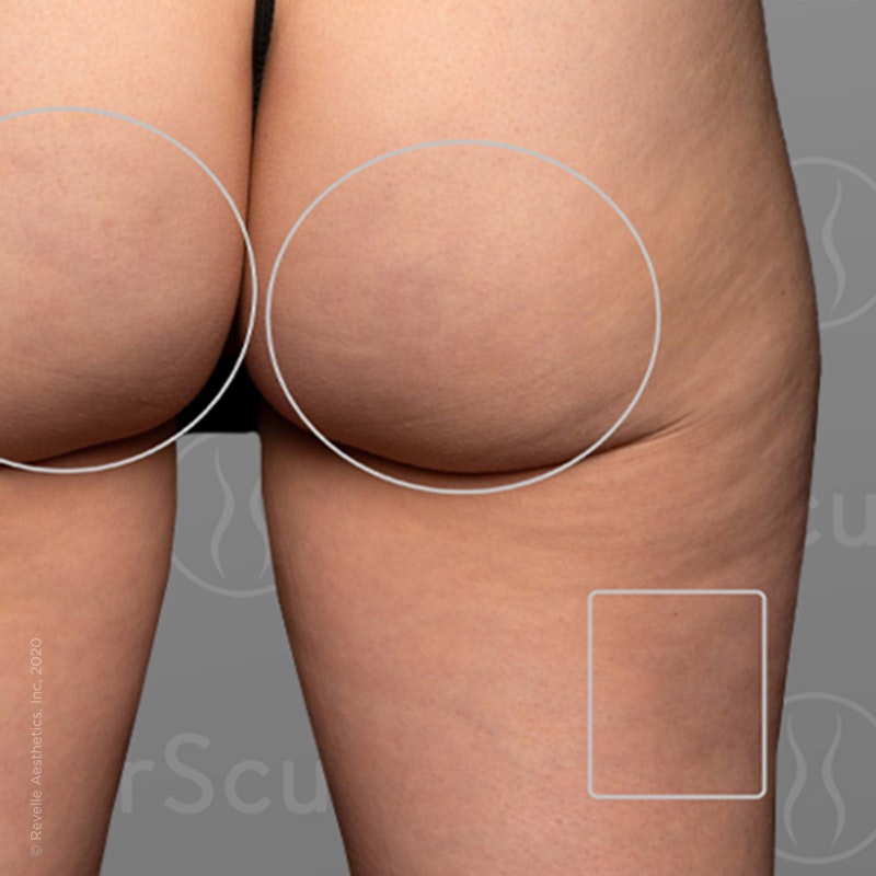 after photo of AirSculpt Smooth cellulite removal