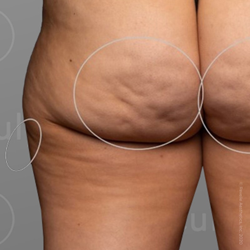 before photo of AirSculpt Smooth cellulite removal