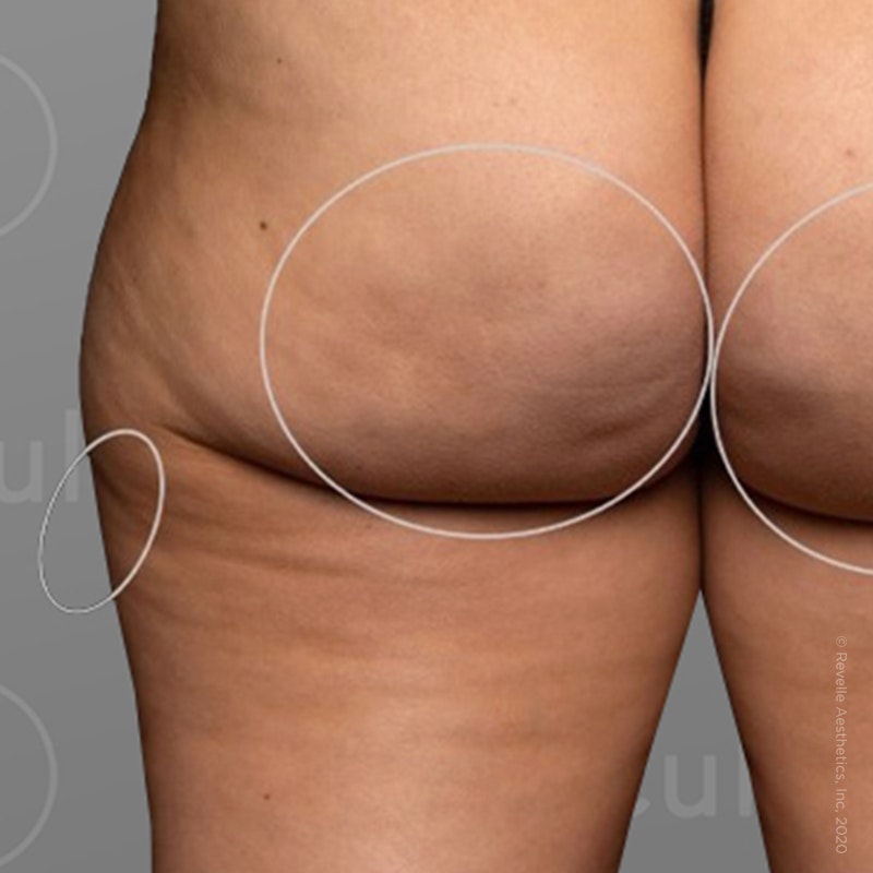after photo of AirSculpt Smooth cellulite removal