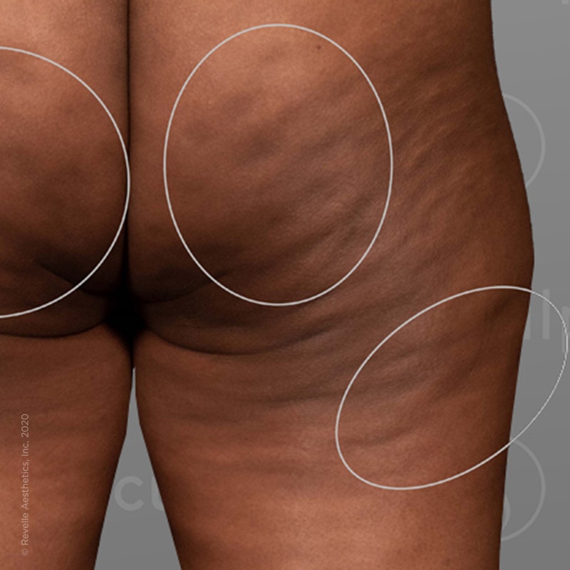before photo of AirSculpt Smooth cellulite removal