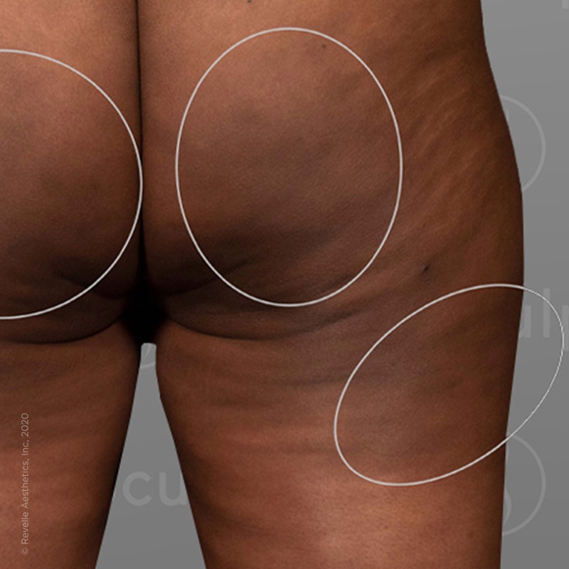 after photo of AirSculpt Smooth cellulite removal