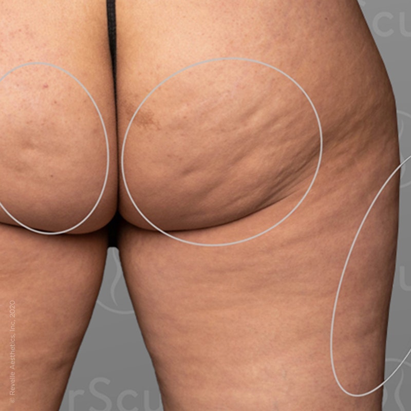 before photo of AirSculpt Smooth cellulite removal