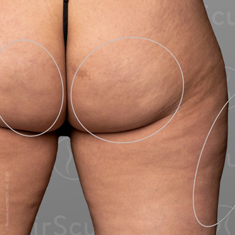 after photo of AirSculpt Smooth cellulite removal