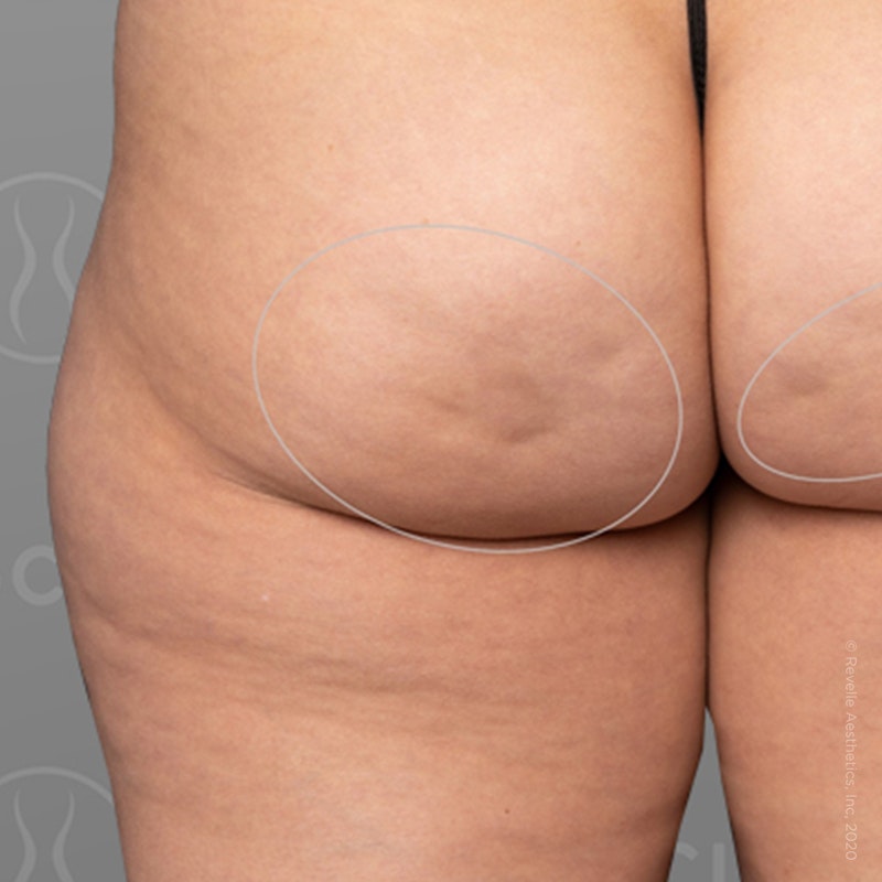 before photo of AirSculpt Smooth cellulite removal