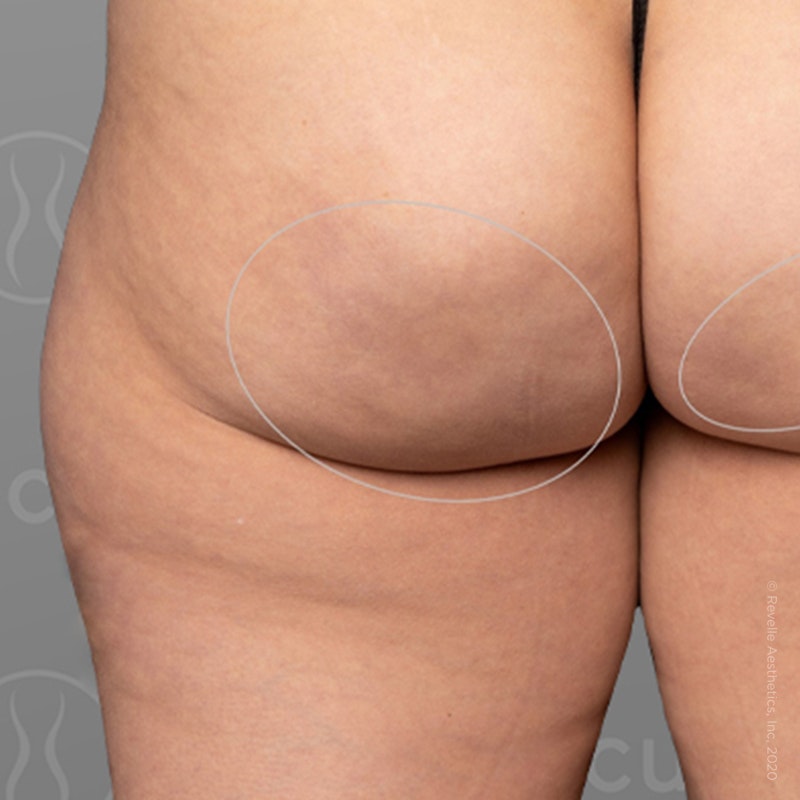 after photo of AirSculpt Smooth cellulite removal