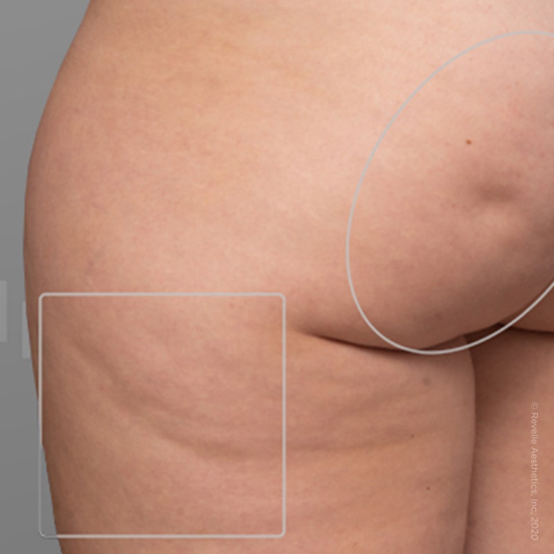 before photo of AirSculpt Smooth cellulite removal