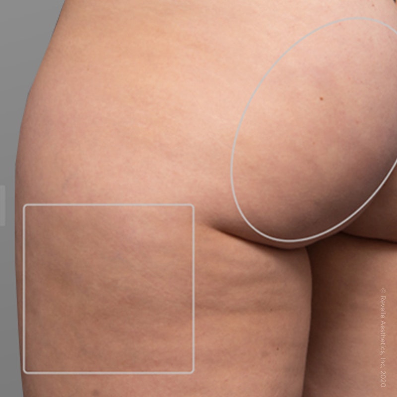 after photo of AirSculpt Smooth cellulite removal