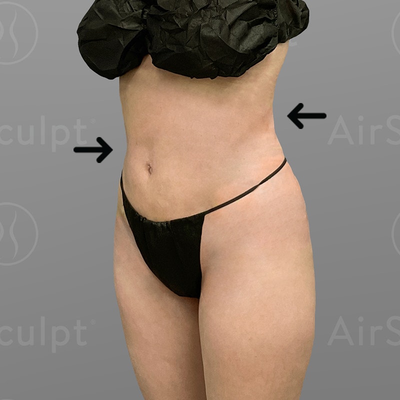 after stomach airsculpt