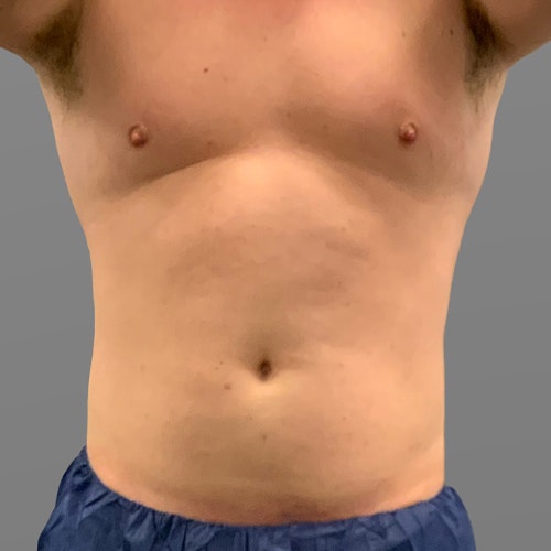 before 48 hour six pack airsculpt