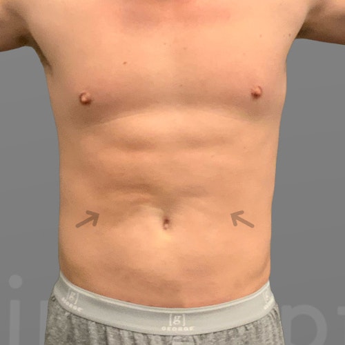after 48 hour six pack airsculpt