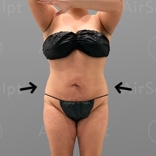 after stomach airsculpt